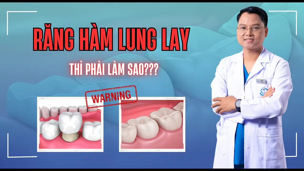 Outline Video Răng hàm bị lung lay thì phải làm sao? | Bác sĩ Cường