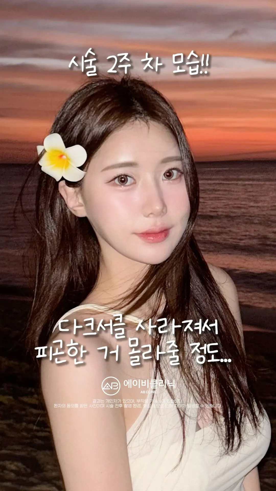 다크서클 지우개 에이빛주사 후기✨