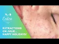 Happy Holidays Blackhead extractions on our dear friend Julie