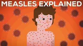 Download Measles Explained — Vaccinate or Not MP3