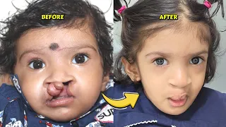 Unbelievable Results A Father S Review Of Dr Parit Ladani S Skill In Cleft Lip Repair 