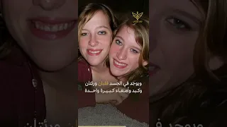 زواج يخلق كثير من الأسئلة حوله ما قصة زواج التوأم الملتصق آبي هنسل وبريتاني 