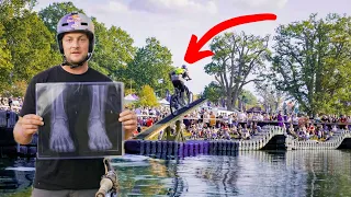 I TRIED THIS CHALLENGE AND BROKE MY LEGS!!