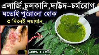 ১০০ বছরের পুরাতন দাদ চুলকানি এলার্জি চিরতরে খতম | দাদ চুলকানি দূর করার ঘরোয়া উপায় | Health Tips