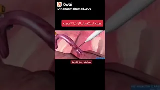 عملية الزائده الدوديه 