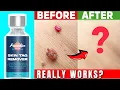 Paradise Skin Tag Remover Truly Effective See This Genuine Review Discover Now