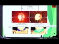 AIOC2026 IC75 Pathophysiology of the Optic Nerve Cupping from Glaucoma Dr Jatinder Singh Bhalla