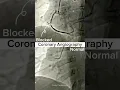 Coronary Angiography (Normal vs Blocked)