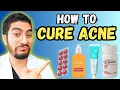 99 Overlook These Effective Acne Treatments - 2025 Guide