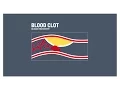 Download Lagu Coronary heart disease, clogged arteries and atherosclerosis