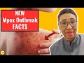 2024 Monkey Pox Mpox Outbreak is DIFFERENT - Here s Why