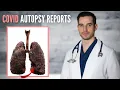 Download Lagu 12 COVID Autopsy Cases Reveal the TRUTH \ Download Lagu 12 COVID Autopsy Cases Reveal the TRUTH \