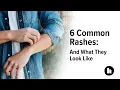 6 Common Rashes And What They Look Like Healthline