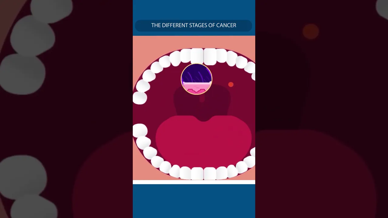 T for Tumor