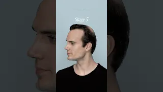 Here S What Each Hair Loss Stage Looks Like  Here S What Each Hair Loss Stage Looks Like