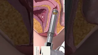 تضيق المهبل بالليزر Dr Mohamad Loay اكسبلور التهاب 