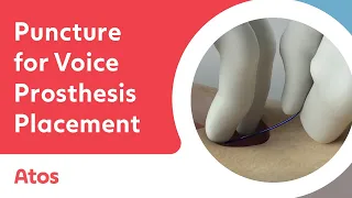Puncture in Laryngectomy: Benefits for Voice Prosthesis Placement