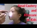 Pediatric Nosebleed Cauterization and Aftercare
