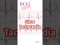 Download Lagu Sinus Tachycardia - Learn ECG in one minute #ecg #ecginterpretation  #medical #medicaleducation
