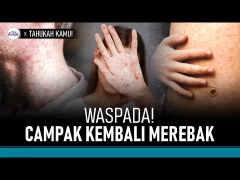 Campak Kembali Merebak, Kenali Bahaya Komplikasinya