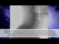 Mobi-C Cervical Disc 7 Dr Michael Peelle talk spine care options