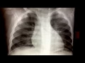 Peri bronchial cuffing - RSV