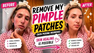 Pimple Patch Removal Remove My Pimple Patches See the Results