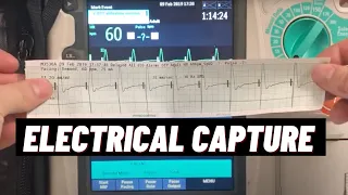 How to confirm Electrical Capture with Transcutaneous Pacing TCP on Philips HeartStart MRx