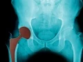Learn about the Northwest Region s Center for Hip and Knee Replacement and Robotic Surgery