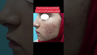 الفراكشنال ليزر مع تسليك الندبات والتقشير الموضعي لعلاج آثار حب شباب ضامره بالوجه فراكشنال ليزر  الفراكشنال ليزر مع تسليك الندبات والتقشير الموضعي لعلاج آثار حب شباب ضامره بالوجه فراكشنال ليزر
