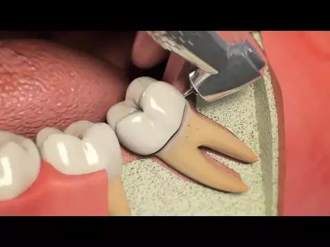 Download MP3 Brocas Cirúrgicas - Prima Dental - Dental Speed