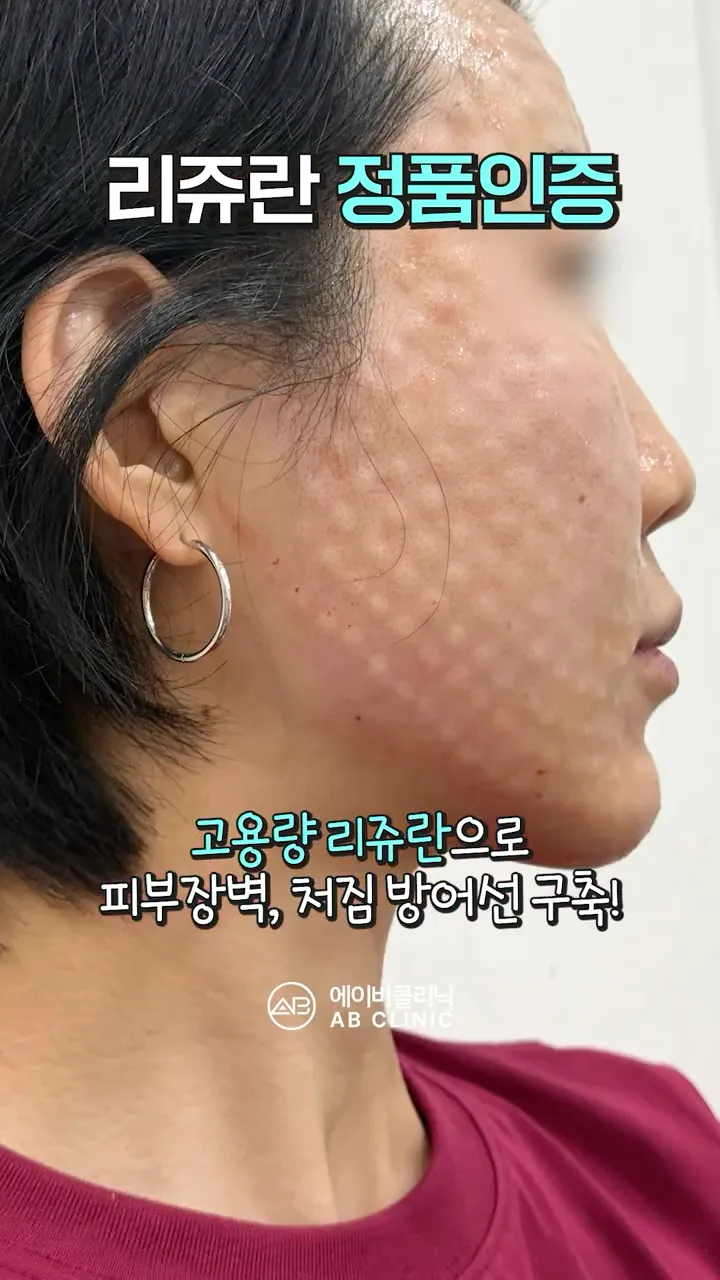 고용량 리쥬란 정품 인증!