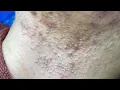 Download Lagu Acne Treatment For \