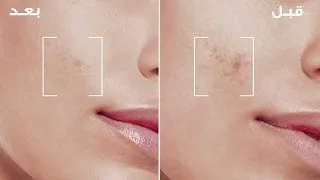 سيروم الجلايكوليك برايت  مع أبتكار ميلاسيل من لوريال باريس دندنها