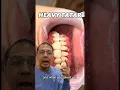 Removing Heavy Tartar Build Up on Lower Anteriors In Office to Hands On Dental Training