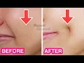 How To Get Dimples Fast Naturally Simple Facial Exercises to get Dimples without Surgery