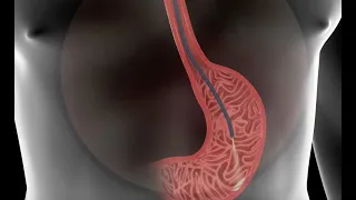 تنظير المعدة كيف يتم الإجراء وعن ماذا يكشف 