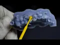 Inlay and Onlay Metal free Restoration Digital Dentistry Smile Galleria