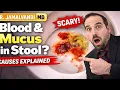 Mucus or Blood in Stool From Harmless Causes to Colon Cancer When to Worry