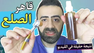 علاج مجرب للصلع و انبات فراغات الشعر طبيعي و بدون زيوت و النتيجة في الڤيديو تشهد 