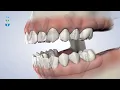 Full-Arch Restoration in Springfield IL at Oral Facial Surgeons of Illinois
