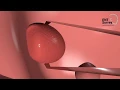 What is the difference between intracapsular and extracapsular tonsillectomy
