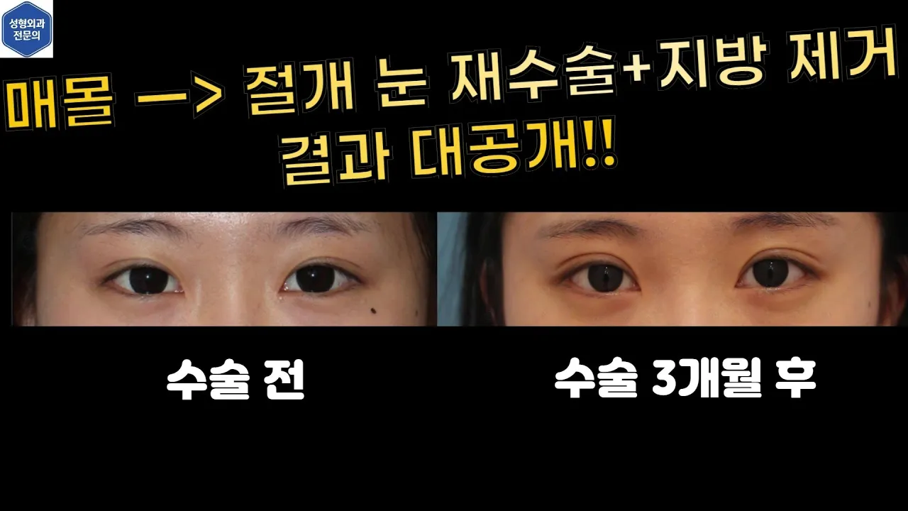매몰 쌍꺼풀 풀고 절개쌍꺼풀로 바꾸는 쌍꺼풀 재수술!!