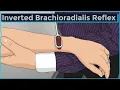Inverted Brachioradialis Reflex C6 C6 Cervical Myelopathy