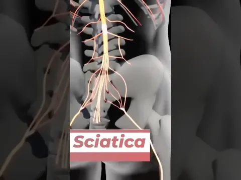 This Causes Sciatica