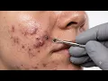 Loan Nguyen Acne Treatment 34zz