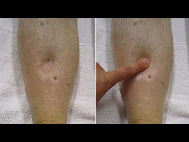 Fisiopatología del Edema, Equipo 3, grupo 402