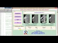 Matlab Project on Breast Cancer Detection using Neural Network Matlab Project Source Code