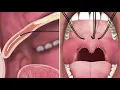 NYOMIS Elevoplasty