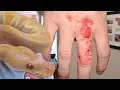 SURPRISE SNAKE BITE BRIAN BARCZYK